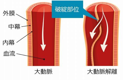 必見 ベルセルク 作者 三浦建太郎さんの死因 急性大動脈解離 本当に怖い病気だった 前兆なく突然走る激痛 即手術しなければ 時間以内に死亡 はちま起稿