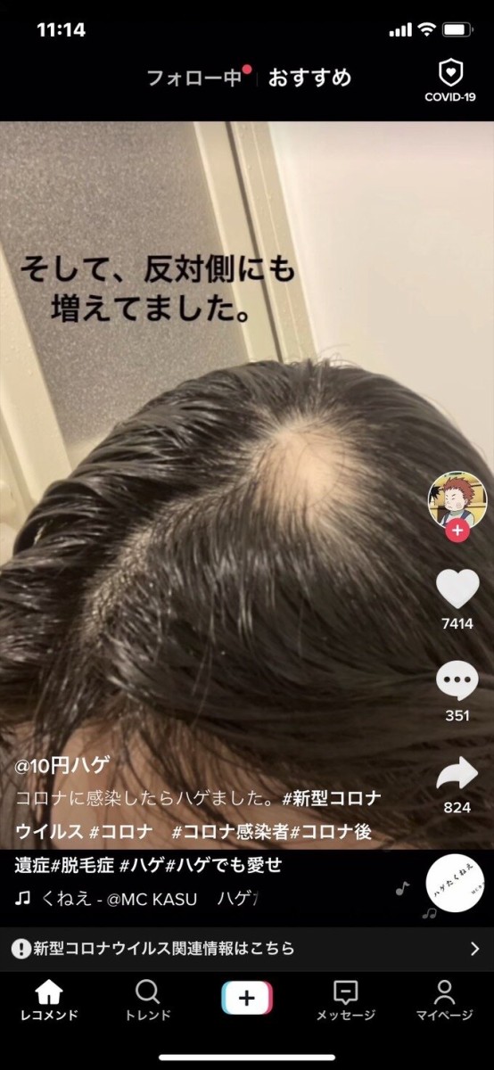 衝撃画像 新型コロナでハゲた女子大生 想像以上にハゲてた はちま起稿