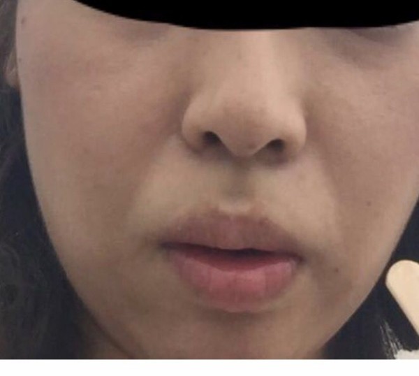 たるみ ほうれい線をなくすスレ Himajyoのまとめ 美容 ダイエット ファッション エンタメ 女子のための2chまとめ