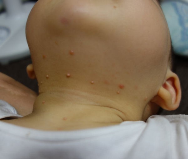 赤ちゃんのお肌の病気 むしむし日記 Max