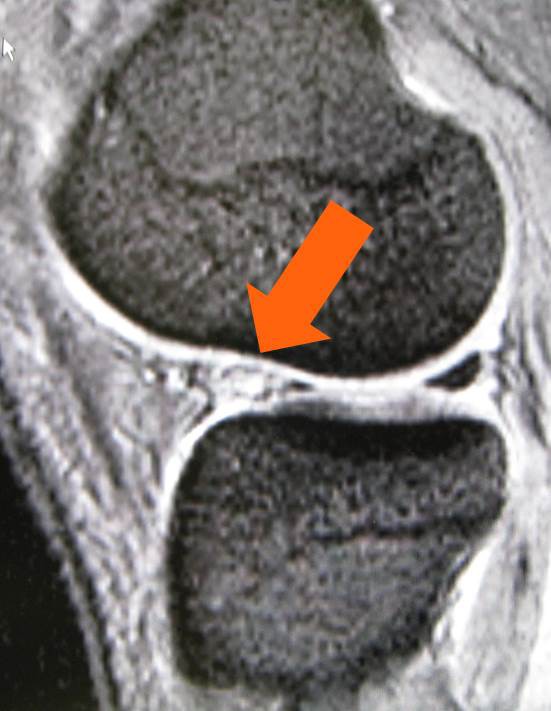 サッカー選手の外側半月板損傷 前節損傷 膝関節鏡外科医のblog