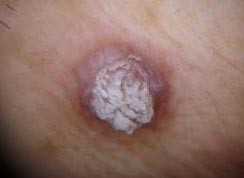 尻にイボできて痛い それ糖尿病の典型的な症状だよ 2pmニュース