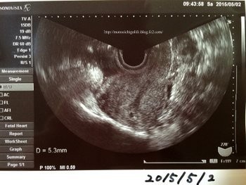 胎嚢 5w0d 妊娠5週目 胎嚢の大きさ・エコー写真、つわり症状や流産のこと