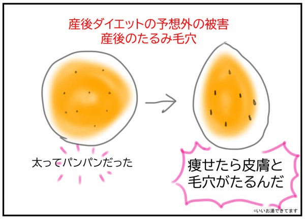 美容 産後のたるみ毛穴 美容皮膚科 いいお湯できてます