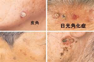 六価クロムに皮膚炎