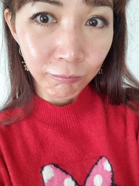 シミ取り放題２回目 韓国ツウへの道 典子の徒然日記