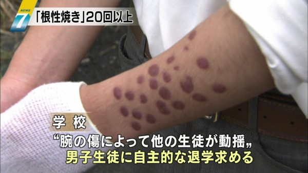 仙台の 根性焼きいじめ 学校側は 自傷 合意による行為 と認識 オレ的はちま講座