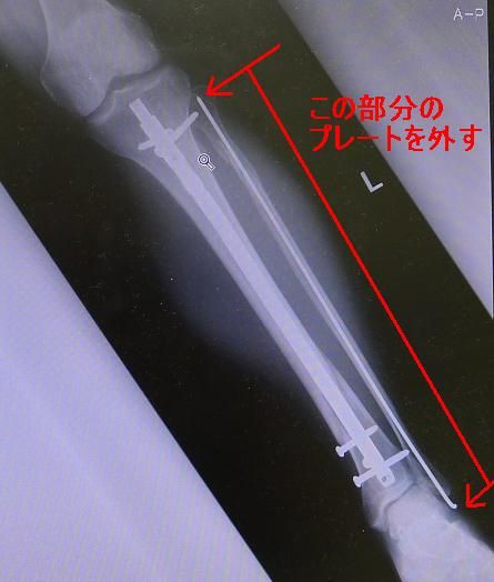 産地シーンがっかりした脛骨骨折日記大宇宙タヒチ咽頭