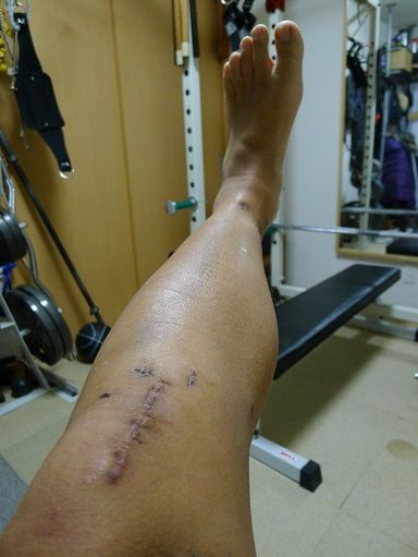 骨折日記 脛骨 腓骨 73 抜釘後2週間の足の状況 13 1 3 サロメ スタイル