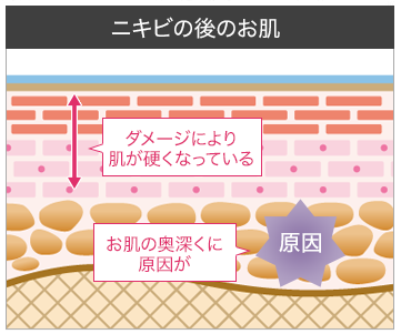 ジッテプラス ニキビ跡 顔って治るのか ジッテプラス 解約 注意すべきポイントは