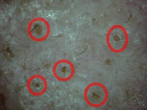 角栓落としまくるのって良くないの 消え去れ 乾燥肌