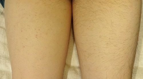 恋冷め 彼氏が他人に コイツ毛深いんですよｗ と私が気にしてること知っててバラして何度もバカにしてくる 女性様 鬼女 生活2chまとめブログ