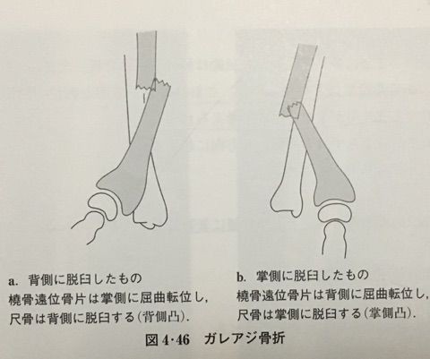 上肢骨折 前腕骨骨幹部骨折 橈骨単独骨折 ガレアジ骨折 柔整学生による柔整学生のためのブログ