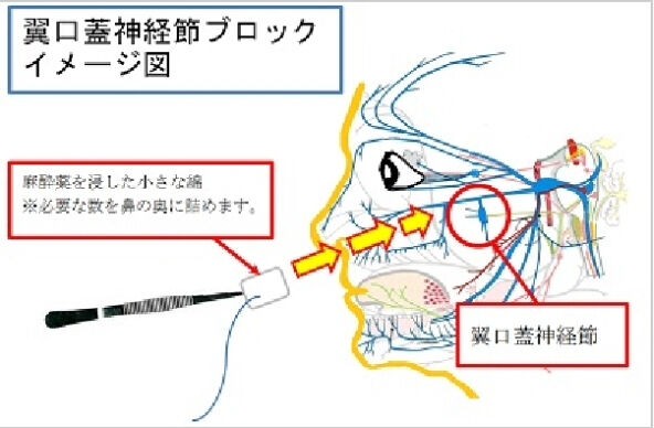 翼口蓋神経節ブロック Haruの頭痛blog