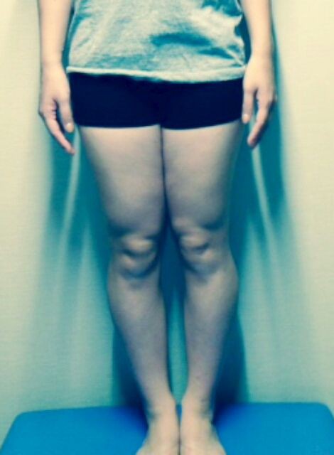 キャビテーション 太もも編 カイロス鍼灸整骨院