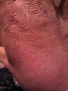 脱ステロイドで学んだ 角質培養という美容理論 手湿疹 脱ステロイド そして角質培養