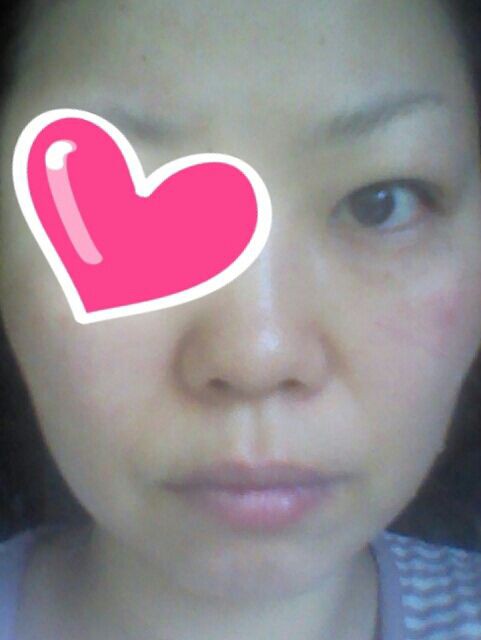 ビフォアアフター 手湿疹 脱ステロイド そして角質培養