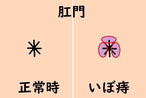 悲報 人生初 痔になる つまらんブログ