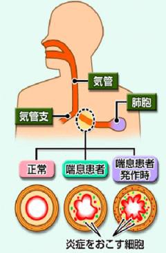 アスピリン中毒と更年期障害のテロリストの兵器攻撃で呼吸不全 慧吏載地衛 帝兜 跿 闍 Catro