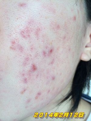 今の状況 花粉とニキビ リプロスキンを６ヶ月使ってからの体験記