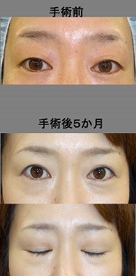 目が大きい人に眼瞼下垂の手術を行うとどうなりますか 名古屋のこいずみ形成クリニックの眼瞼下垂コラム 目が大きい人に眼瞼下垂の手術を行うとどうなりますか 名古屋のこいずみ形成クリニックの眼瞼下垂コラム