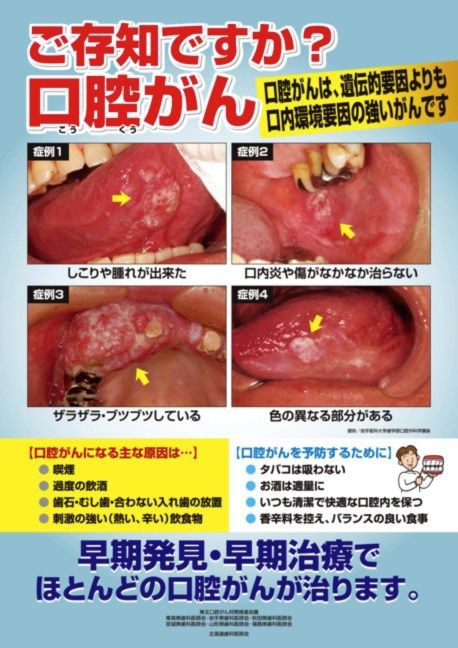 舌がんについて 豊橋の小間歯科医院のブログ