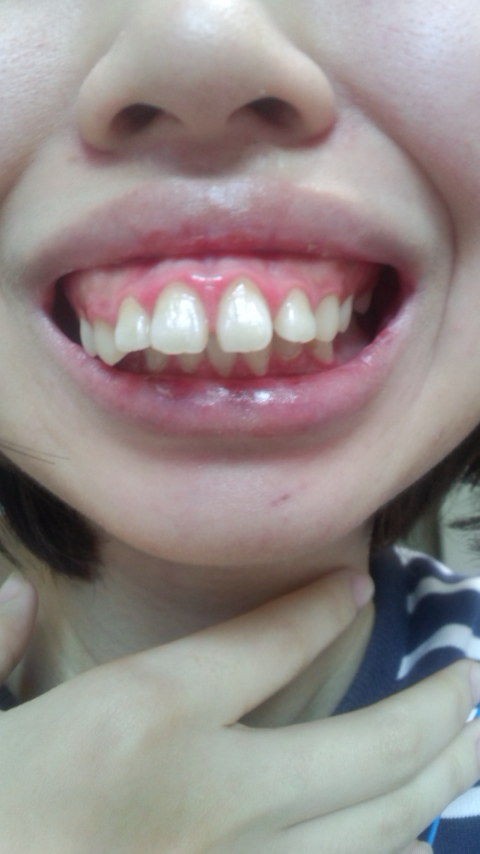 画像 18歳女子高生 私って出っ歯ですか 美味しい毒