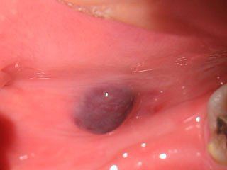 口内炎の画像と特徴 見るだけでも痛いです グロいので注意 口内炎の治し方や 原因を知り 早く治す方法