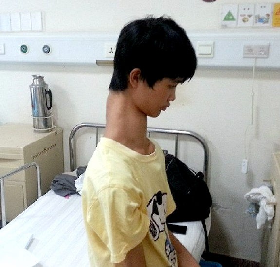 米津玄師 マルハン症候群という難病により顔や体の骨格がおかしかったと判明 かっちゃんの人気の芸能速報 米津玄師 マルハン症候群という難病により顔や体の骨格がおかしかったと判明 かっちゃんの人気の芸能速報