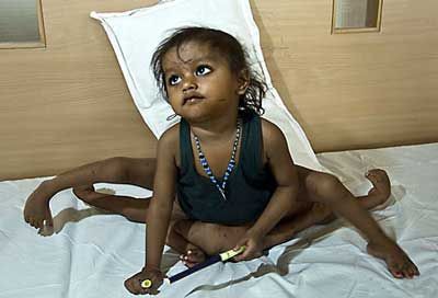 インドで手足が8本ある少女が切断手術することに らばq