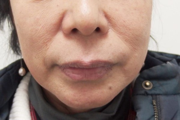 Newaリフト エステナード ララルーチュレジーナの違いを比較してみた 美顔器 おすすめ 小顔 実際に使って比較した体験ブログ