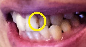 シミ 前歯 茶色い これが歯の茶色い点や線、シミの正体！ 虫歯と汚れの見分け方と対処法｜