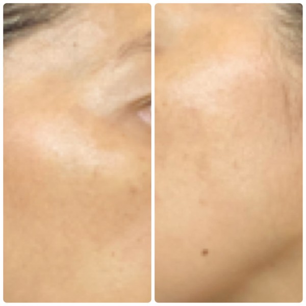 マスク生活の間にやっちゃえシミ取り 3か月後途中報告 まめ S Home Powered By ライブドアブログ マスク生活の間にやっちゃえシミ取り 3か月後途中報告 まめ S Home Powered By ライブドアブログ