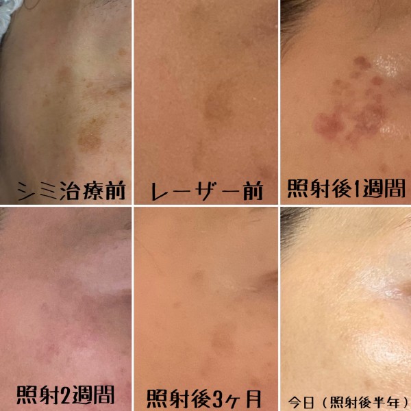 マスク生活の間にやっちゃえ Qスイッチyagレーザーでシミ取り 最終報告 まめ S Home Powered By ライブドアブログ マスク生活の間にやっちゃえ Qスイッチyagレーザーでシミ取り 最終報告 まめ S Home Powered By ライブドアブログ