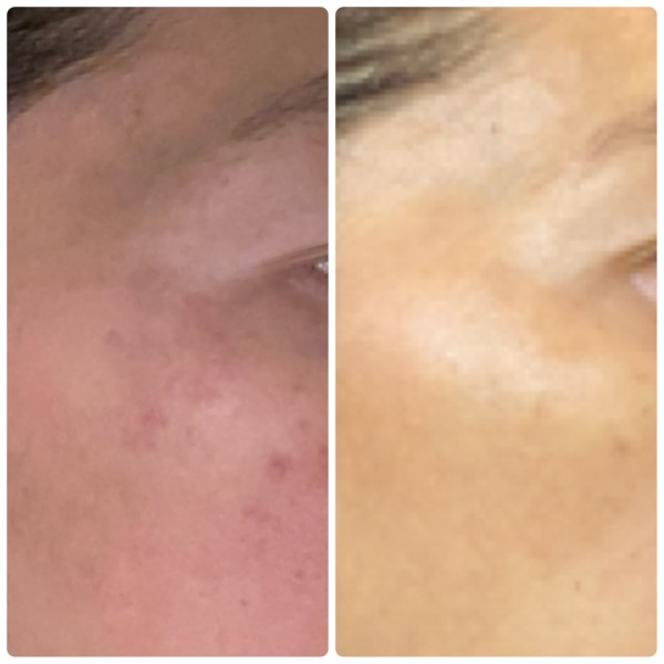 マスク生活の間にやっちゃえシミ取り 3か月後途中報告 まめ S Home Powered By ライブドアブログ マスク生活の間にやっちゃえシミ取り 3か月後途中報告 まめ S Home Powered By ライブドアブログ