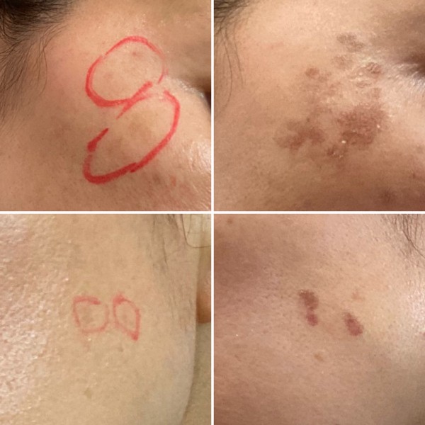 マスク生活の間にやっちゃえ Qスイッチyagレーザーでシミ取り 途中経過報告 まめ S Home Powered By ライブドアブログ マスク生活の間にやっちゃえ Qスイッチyagレーザーでシミ取り 途中経過報告 まめ S Home Powered By ライブドアブログ