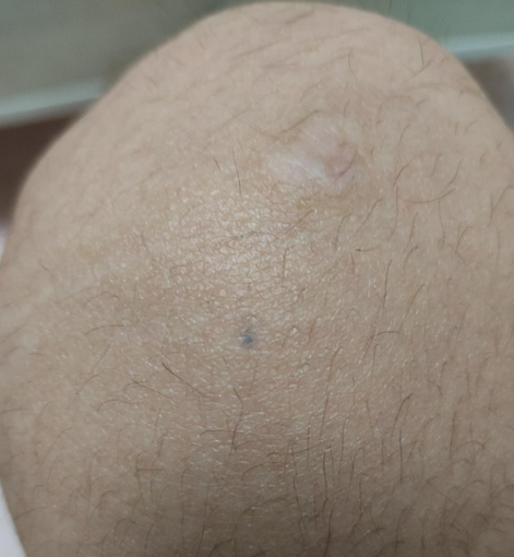 緊急 体内に鉛筆の芯が入っているj民集合 まる検ニュース