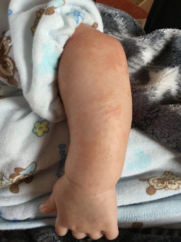 生後２カ月 乳児湿疹 手足ガサガサ アレルギー Meguのまいにち記録 ４児ままの育児日記