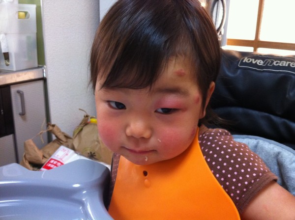乳幼児の蚊にさされ あなどるなかれ みどのblog