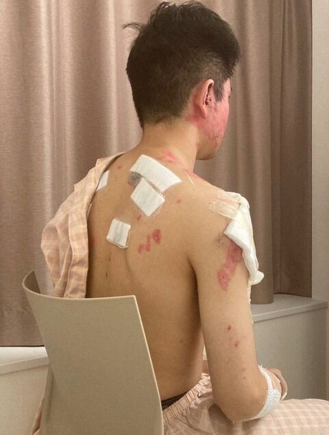 硫酸ぶっかけ男の被害者 顔など右半分がやけどで赤く変色 片目は医療用コンタクトレンズをつけないと見えない状態に 画像あり ミラクルミルク