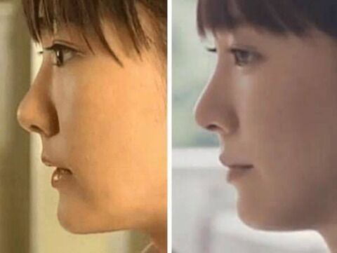 画像 女の子さん 成長とともにブタ鼻がスッキリ鼻になるｗｗｗｗｗｗｗｗｗｗｗｗｗｗｗｗｗｗｗｗｗｗｗｗｗｗｗ ミラクルミルク