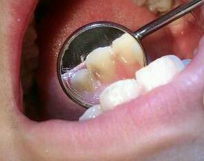 虫歯の治療 みやうちデンタルケアの スタッフブログ
