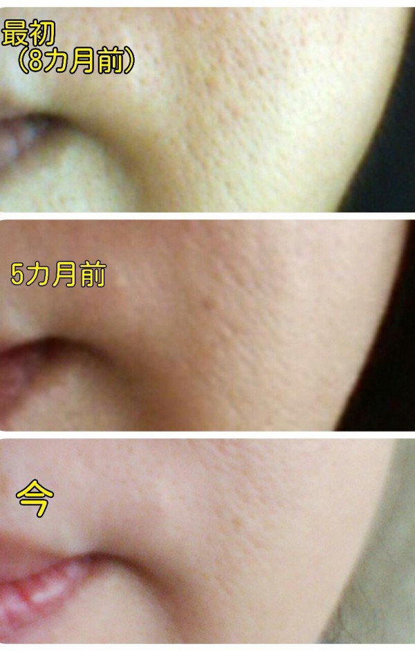 改善が一番難しい肌悩み 毛穴 珠肌へまっしぐら 珠肌ブログ