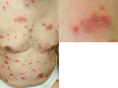 重症の薬疹 : 落書き帳2