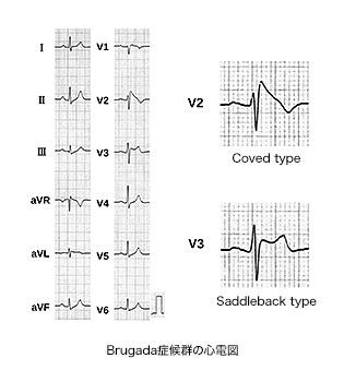 ブルガダ 心電図 ブルガダ型心電図といわれた