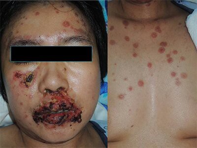 重症の薬疹 落書き帳2