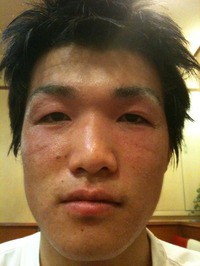 アトピー治療体験記 7月18日 Moribrotherのブログ