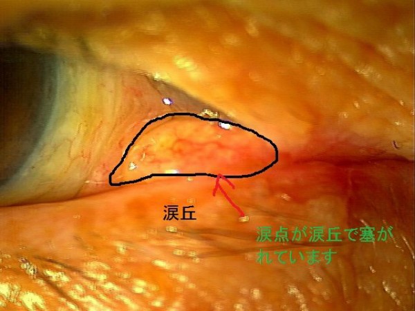 涙目に対する涙丘切除術 もりや眼科 森谷充雄が眼科の事を分かりやすく説明します