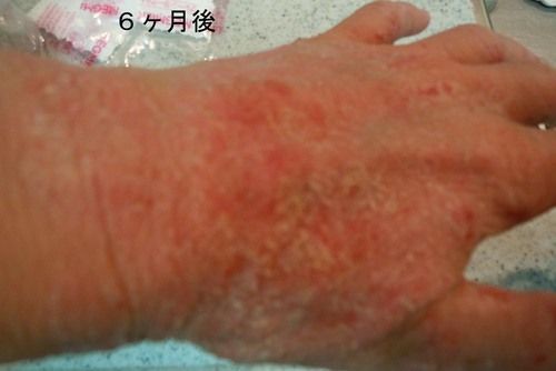 手湿疹から始まるリバウンド ステロイド皮膚症 アトピー性皮膚炎のステロイド外用剤離脱 ミラー