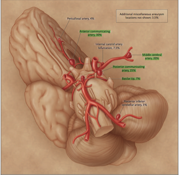 中大脳動脈瘤(MCA Aneurysm)のすべて: シミュレーションで経験する手術・IVR 50本のWEB動画付き  (脳神経外科速報EX部位別に学ぶ脳動脈瘤シリーズ) | 宝金 清博, 井川 房夫, 宮地 茂 |本 | 通販 | Amazon